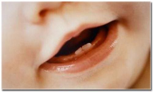 Dentes de leite podem gerar células-tronco para tratamento