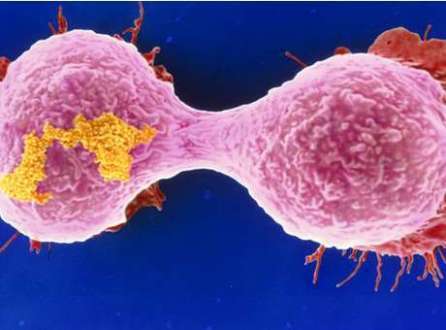 Mutação genética que leva à leucemia também pode causar câncer de mama agressivo