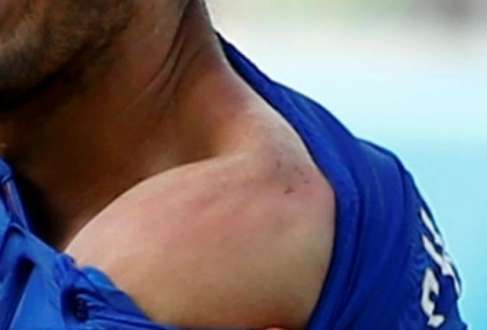 Chiellini mostra marca dos dentes de Suárez, após mordida no ombro