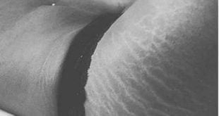 A participante não é mãe e disse que tem estrias desde o ensino médio