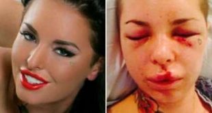 Christy Mack ficou com o rosto deformado após agressão de lutador de MMA