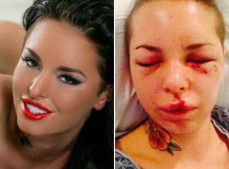Christy Mack ficou com o rosto deformado após agressão de lutador de MMA