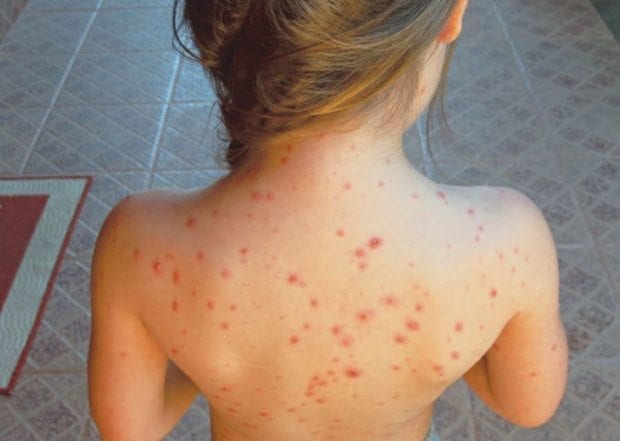 Saúde - Com a primavera, alerta total contra a catapora