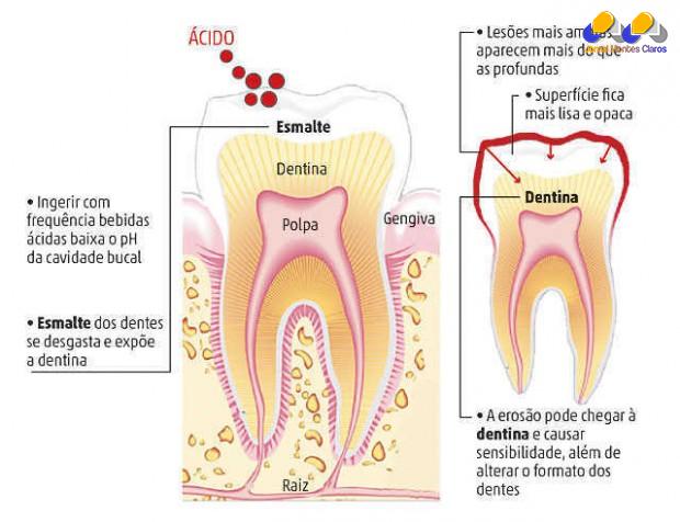 Estudo recente publicado pela Universidade de Adelaide, na Austrália, alerta para os riscos da erosão dentária, desgaste do esmalte provocado pela ação química de ácidos