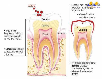 Estudo recente publicado pela Universidade de Adelaide, na Austrália, alerta para os riscos da erosão dentária, desgaste do esmalte provocado pela ação química de ácidos