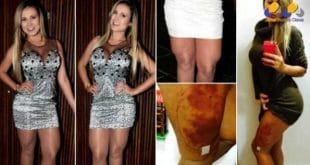 Andressa Urach está internada em estado grave desde o último sábado (29) por conta de complicações causadas pela aplicação de hidrogel na perna