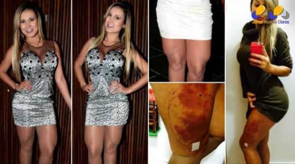Andressa Urach está internada em estado grave desde o último sábado (29) por conta de complicações causadas pela aplicação de hidrogel na perna