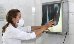 Saúde - Exame para detectar tuberculose torna diagnóstico 100% mais rápido