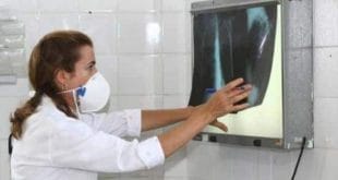 Saúde - Exame para detectar tuberculose torna diagnóstico 100% mais rápido