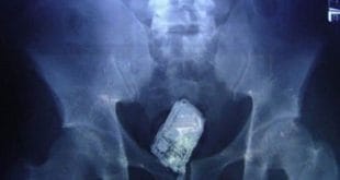Montes Claros - Detento é flagrado com celular no intestino