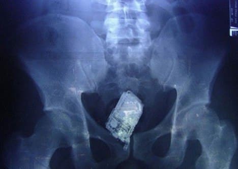 Montes Claros - Detento é flagrado com celular no intestino