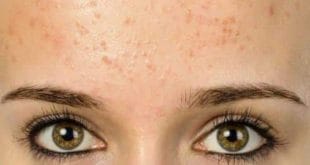Beleza - Marquinhas no rosto? Cuidado, acne pode piorar no verão