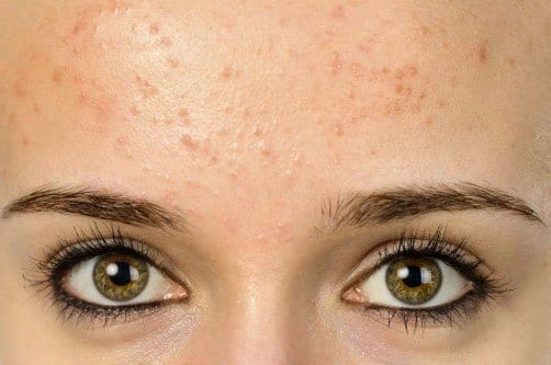 Beleza - Marquinhas no rosto? Cuidado, acne pode piorar no verão