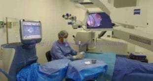 A cirurgia com laser possibilita a redução do tempo de cicatrização, oferece mais precisão, segurança e independência dos olhos
