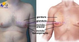 Ginecomastia é uma cirurgia plástica que faz redução mamária masculina.
