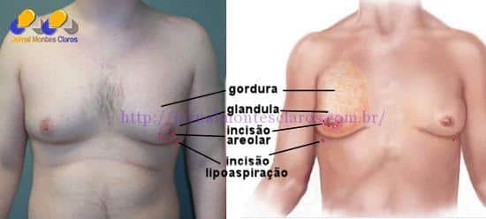 Ginecomastia é uma cirurgia plástica que faz redução mamária masculina.