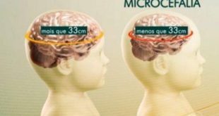 MG - Estado de Minas Gerais investiga Zika em três casos de microcefalia