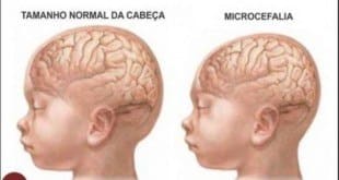 MG - Duas mortes de bebês com microcefalia são investigadas em Minas Gerais