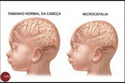 MG - Duas mortes de bebês com microcefalia são investigadas em Minas Gerais