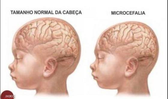 MG - Duas mortes de bebês com microcefalia são investigadas em Minas Gerais