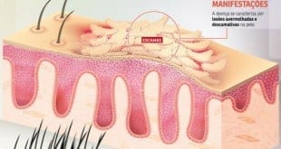 Saúde - Sociedade Brasileira de Dermatologia chama população para contribuir no protocolo clínico de Psoríase‏
