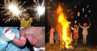 Saúde - Riscos de queimaduras em tempos de Festas Juninas‏