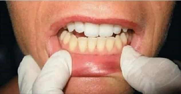 Saúde - Clareamento dental: Tire suas dúvidas