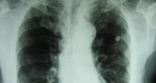 Saúde - Tuberculose preocupa e ainda faz vítimas no País