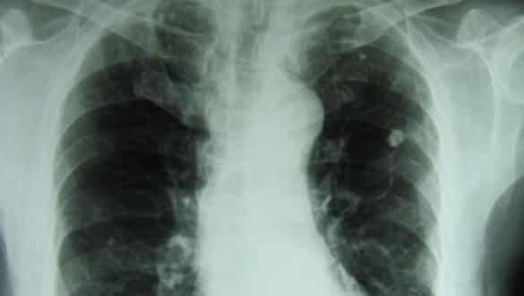 Saúde - Tuberculose preocupa e ainda faz vítimas no País