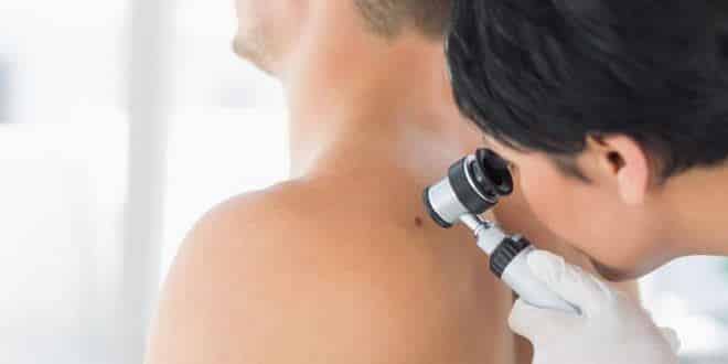 Saúde - Dúvidas mais comuns sobre câncer de pele