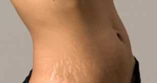 Beleza - Como evitar o surgimento de estrias durante a puberdade