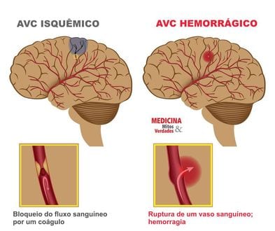Saúde - Campanha educativa on-line quer chamar atenção para perigos do AVC