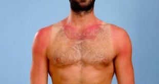 Saúde - Uma em cada quatro pessoas admite que não se protege do sol