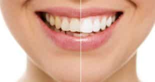 Beleza - Mitos e verdades sobre clareamento dental