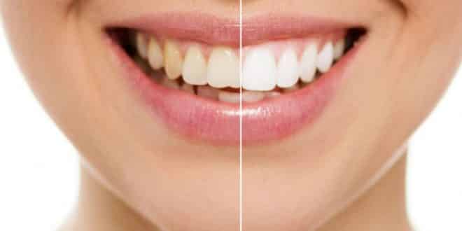 Beleza - Mitos e verdades sobre clareamento dental