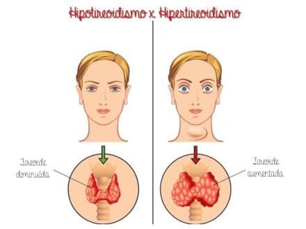 Hipo e hipertireoidismo desequilibram todo o organismo