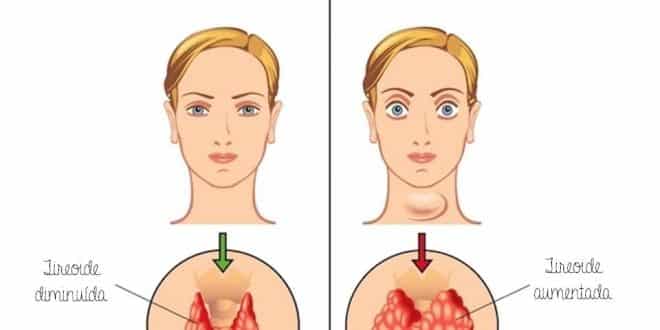 Hipo e hipertireoidismo desequilibram todo o organismo