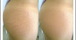 Diminuir as estrias é possível sim
