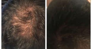 Alessandro Carvalho, um dos voluntários na fase de teste do produto mostra o resultado dos três meses de tratamento com o tônico capilar