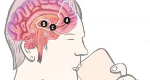 Abuso de álcool na adolescência pode ‘deformar’ o cérebro