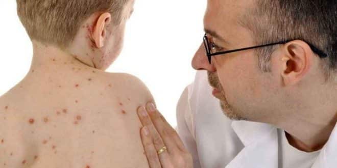 Saiba mais sobre o sarampo e como combater à doença