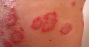 SUS oferece mais quatro medicamentos para tratar psoríase