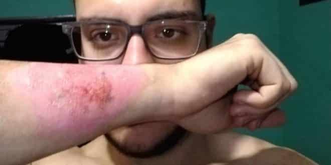 Argentino 'apaga' tatuagem com ralador de queijo