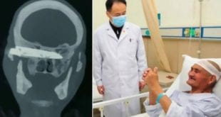 Após 26 anos, chinês consegue fazer cirurgia para retirar lâmina alojada em seu crânio