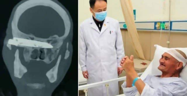 Após 26 anos, chinês consegue fazer cirurgia para retirar lâmina alojada em seu crânio