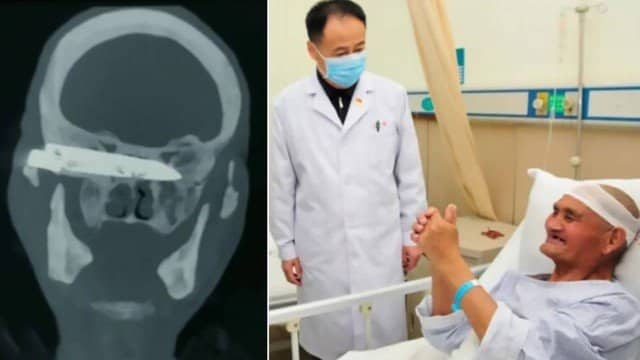 Após 26 anos, chinês consegue fazer cirurgia para retirar lâmina alojada em seu crânio
