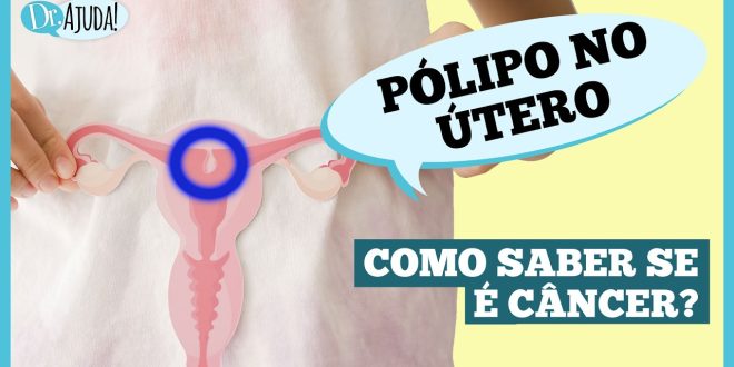 O que são pólipos uterino e quais os sintomas?