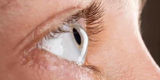 Ceratocone: doença ocular silenciosa é uma das principais causas de transplante de córnea no Brasil